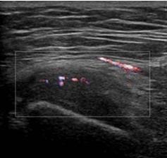ultrasoundcases.info transversaal: tendinopathie M.
