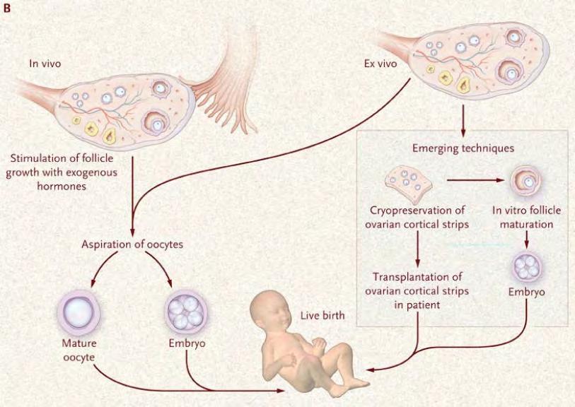 Mogelijke interventies voor fertiliteitspreservatie Laparoscopische ovariectomie Ovariële