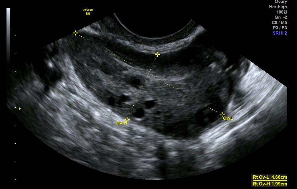 ER+ borst CA 34j Familiale ATCD borst CA PCOS AMH 34 ng/ml; AFC >50 /ovarium