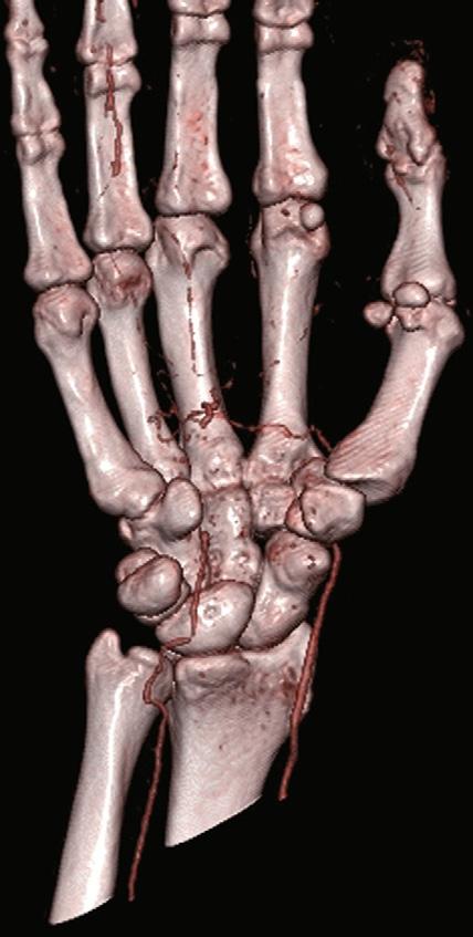 hamulus occlusie kanaal van Guyon A. ulnaris A. radialis FIGUUR 3 3D-reconstructie van CT-angiografie van de rechter hand van patiënt A. Het verloop van de A.