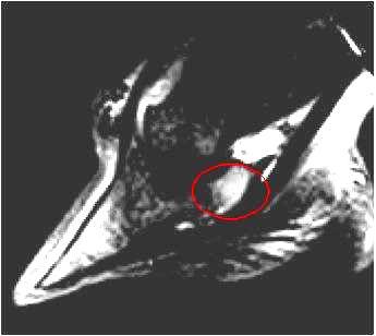 Figuur 14a (links) en 14b (rechts): Sagittale MRI-opname van de voet van dezelfde patiënt. Duidelijk zichtbaar is het botoedeem ter hoogte van het straalbeen (omcirkeld).