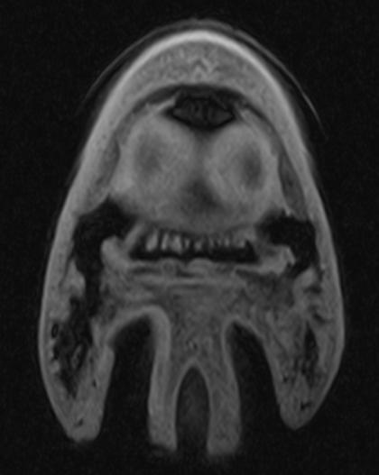 Figuur 31: MRI beeld van de rechter voet,