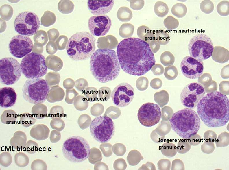 Leukocytose Myeloïde