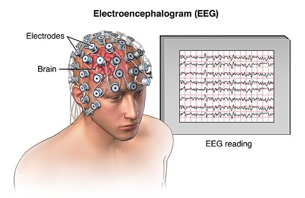 Medische interventies Epileptische activiteit