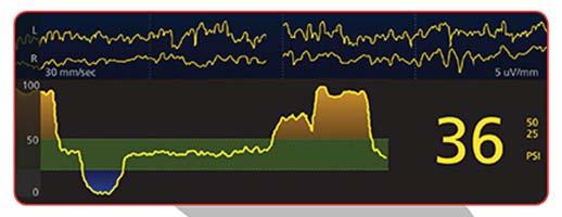 Rol Practitioner Innovaties & materiaalkeuzes Bulbus Jugularis Catheter