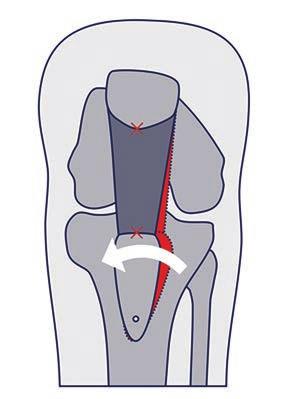 The tubercle becomes aligned with the patella by the pull of the patellar tendon, and positions itself in the centre of the trochlear groove.