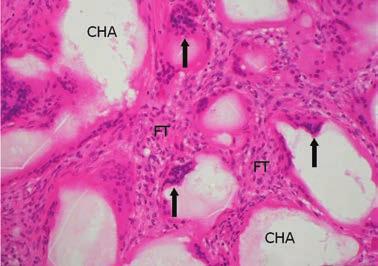 tissue (FT) containing numerous macrophages and multinucleated giant cells (arrows).
