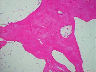 Chapter 9 Bone Graft The bone graft had been mostly remodeled into a new bone structure (Figure 6).