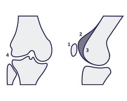 4: A shortening of the lateral femoral condyle Figure 4 Classification of the shape of the femoral trochlea according to Dejour et al.