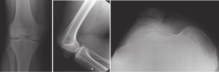 Chapter 4 was no association between a short lateral condyle on the AP view and prominence of the anterior surface of the lateral femoral condyle on the lateral view (chi-squared test, p = 0.