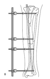4: Intramedullaire pin in combinatie met: B) externe fixatie, C) cerclage D) Interlocking nails uit (Jonsson & Dunning, 2005)