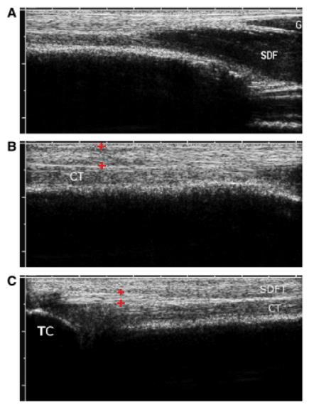 Fig. 8: Longitudinale echografische beelden van de achillespees van de hond. In alle foto s is rechts proximaal. A) Helemaal proximaal, de musculotendineuze overgang van de M.