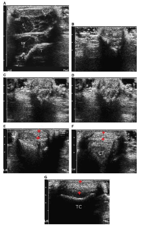 Fig. 9: Transversale echografische beelden van de achillespees van de hond. In alle afbeeldingen ligt mediaal rechts.