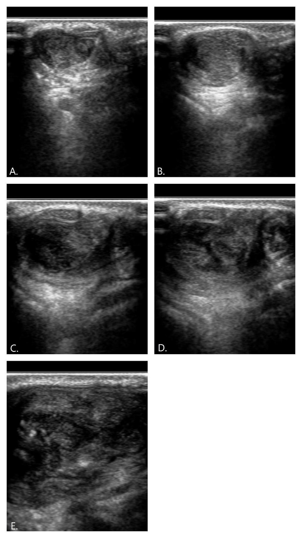 Fig. 11: Transversale echografische beelden van de linker achillespees van de hond. In alle afbeeldingen ligt mediaal rechts. A) meest proximaal op 40% tibialengte. B) 30% tibialengte.