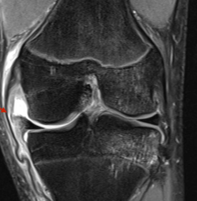 Aanvullend onderzoek Meestal niets X alleen bij uitsluiten fractuur (Ottawa regels: onbelastbaar na trauma en geen 4 stappen in spreekkamer, gelokaliseerde