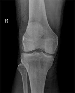 Voorste kruisband letsel Zwelling binnen enkele uren Niet/nauwelijks belastbaar Exo/valgus letsel Unhappy triad OK indicatie bij combinatie kraakbeen/meniscus