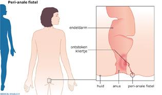 Inleiding Binnenkort wordt u geopereerd aan een fistel bij de anus. Deze folder geeft u informatie over een fistel bij de anus en de behandeling daarvan.
