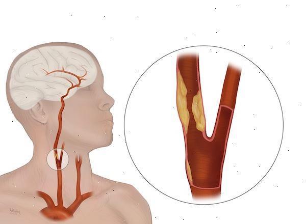 Symptomatisch carotislijden Symptomatisch = elke patiënt die in de afgelopen 6 maanden neurologische symptomen/uitval had vanuit carotisgebied Carotisgebied Hemi-sensorische stoornissen