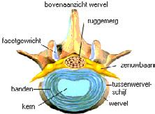 Hernia Een hernia is een ander woord voor een uitstulping. Een uitstulping van de tussenwervelschijf wordt ook wel een Hernia Nuclei Pulposi (HNP) genoemd.