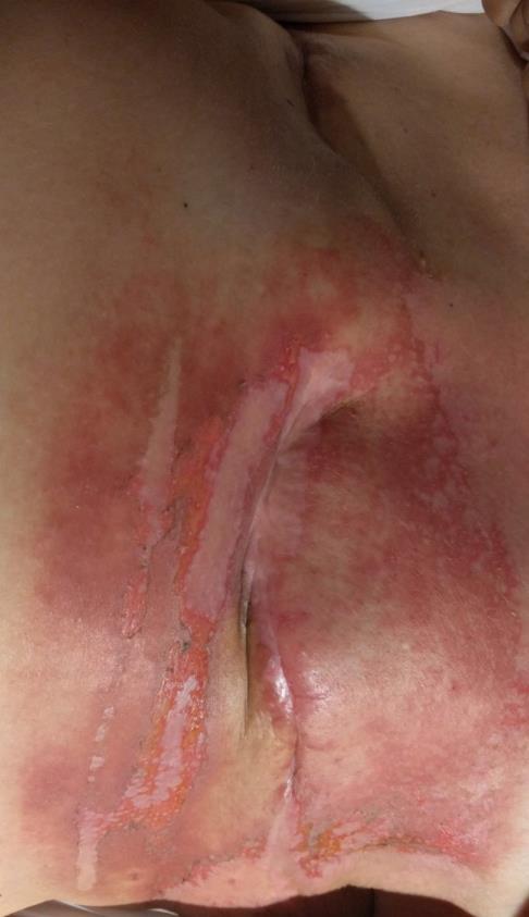 BIJWERKINGEN Operatie necrose wond litteken linker borst. Verstopte drain rechter borst doordat vacuüm niet aangezet.