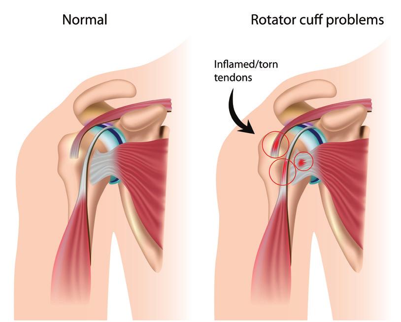 Algemeen In overleg met uw orthopedisch chirurg heeft u besloten een rotator cuff repair van de schouder uit te laten voeren.