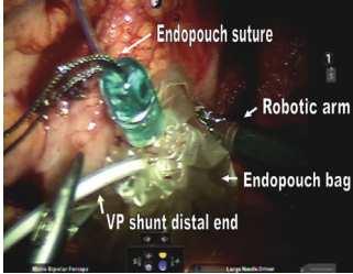 Marchetti et al (2011) 4 kinderen, robotchirurgie Endopouch bag: distale uiteinde in een pouch