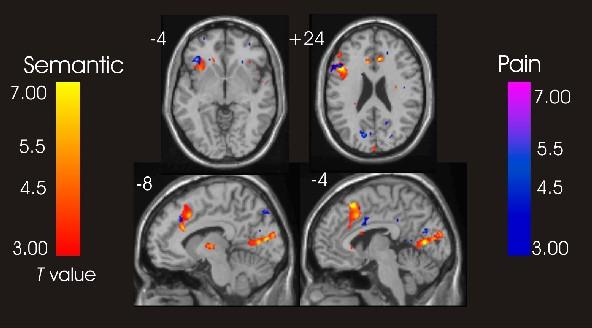 Diagnostiek - Gewaarwording Objectief Functionele MRI Veranderingen