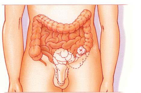Stoma van de dikke darm Een stoma is een kunstmatige uitgang van de darm in de huid van de buik. Een stoma heeft geen sluitspier. Hierdoor kunt u de ontlasting niet ophouden.