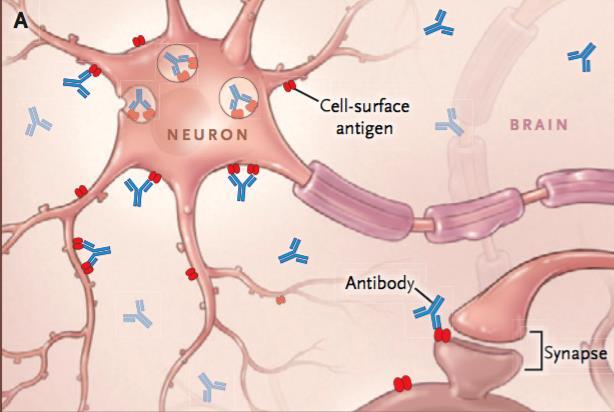 Anti-neuronale auto-immuun encefalitis Ontsteking van het hersenweefsel Antistoffen tegen