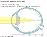Een onscherp beeld is dan het gevolg. Door middel van correctie van de bijziendheid in de vorm van een min-bril vindt afbeelding weer plaats op het netvlies.