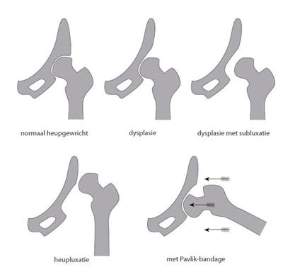 Heupafwijkingen bij pasgeborenen (heupdysplasie) Heupdysplasie is een afwijking van het heupgewricht, waarbij de heupkom te ondiep is.