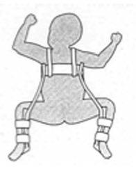 Afbeelding 2 Afbeelding 3 Symptomen Een kind met heupdysplasie kan de volgende verschijnselen hebben: Als het kind op de buik ligt, kunnen er bij de billen ongelijke
