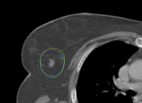Better radiotherapy tumor coverage CTV tumor + 2 cm Post-operative vd Leij