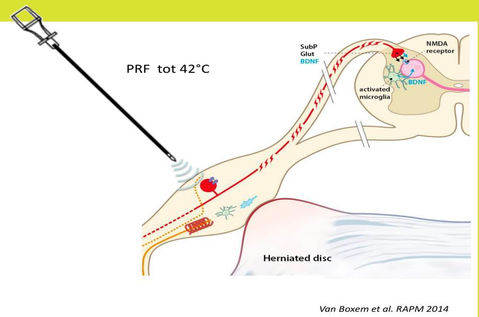 PRF cervicale spinale ganglion voor chronische cervicobrachialgie RCT (van Zundert et al.