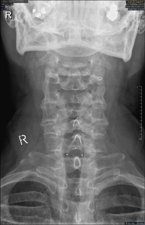 MRI: discus extrusie C6C7 links EMG: acuut C7 lijden