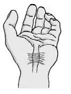 Deze zenuw verloopt van de onderarm naar de handpalm via een tunnel, die wordt gevormd door de handwortelbeentjes en een stevig peesblad (de dwarse polsband).