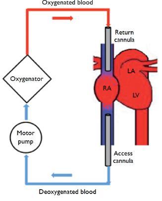 VORICONAZOLE TIJDENS ECMO Inleiding Laa