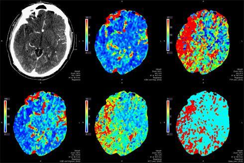 Twee studies in NEJM IAT effectief 6 24 uur Met CT-perfusie is het mogelijk patiënten te selecteren die tussen de 6 en 24 uur tevoren hun herseninfarct hebben gekregen en die toch nog veel verbeteren