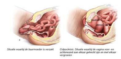 Wat is een colpocleisis? Een colpocleisis is een operatie die de symptomen van de verzakking weghaalt door de vagina voor- en achterwand met elkaar te laten vergroeien.
