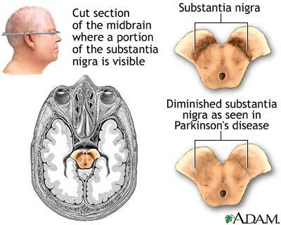 Pathofysiologie Parkinson Ziekte van Parkinson dopamine cellen pars compacta substantia nigra Atypische parkinsonismen: