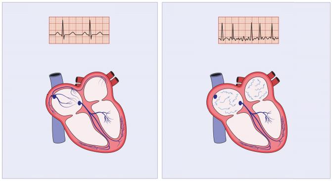 2 Wat is voorkamerfibrillatie? Normaal hartritme Hartritme VKF Bij VKF is de elektrische prikkeling in de voorkamers verstoord.
