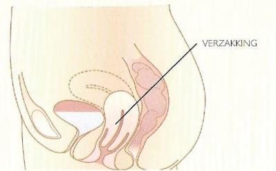 verzakking verzakking Sacrospinale fixatie Wanneer de vaginatop of baarmoeder verzakt is, kan dit operatief verholpen worden met een sacrospinale fixatie.