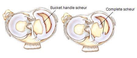 Er zijn tal van redenen om een artroscopie van een knie uit te voeren (simpele spoeling bij kristalaandoeningen of infectie, verwijderen van losse stukjes (gewrichtsmuizen), kraakbeentransplantatie,