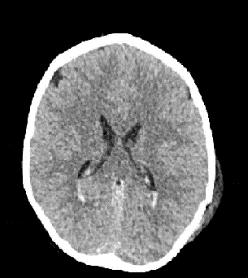 Noradrenaline D E3M5Vt;