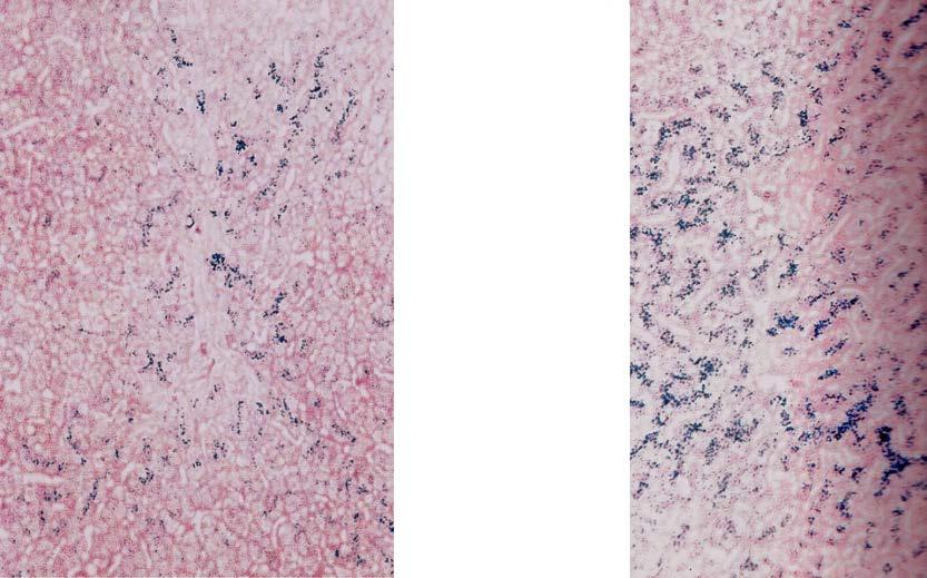 Bij hemochromatose patiënten wordt er minder hepcidine geproduceerd, zodat de poortjes geheel open staan en vanuit de darm meer ijzer wordt opgenomen in de bloedbaan dan het lichaam nodig heeft,