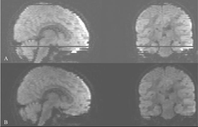 Met behulp van geoptimaliseerde algoritmen zijn afwijkende zwakke delen van elke scan herkend, verwijderd uit de dataset en vervangen op basis van de resterende data (Figuur 9). Figuur 9.