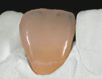 Kleur aanbrengen in het incisale gebied (aanpassen van de translucentie) Om de translucentie van het incisale gebied te versterken en de weerkaatsing van