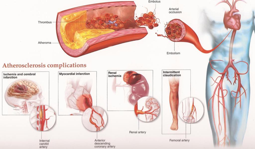 Atherosclerose