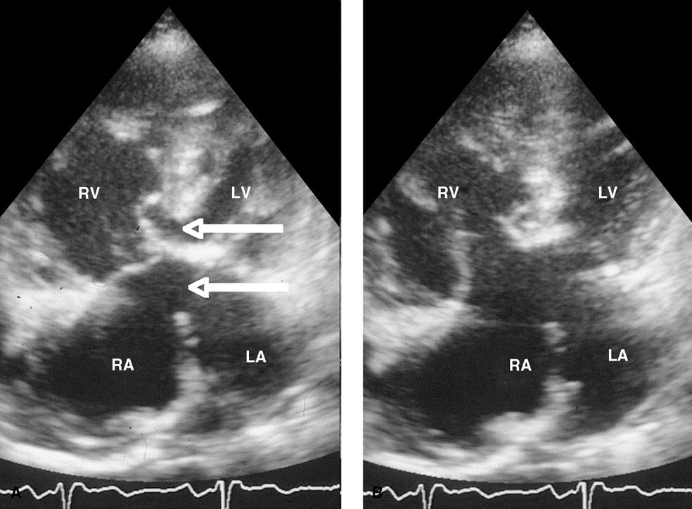 66 Hoofdstuk Atrioventriculair septumdefect. Figuur.