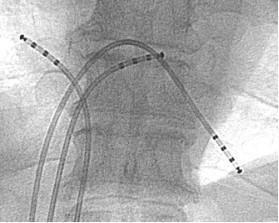 Hartkatheterisatie Hartkatheterisatie ofwel coronair angiografie is een doorslaggevend onderzoek als het gaat om vernauwde kransslagaders, maar kan ook voor andere onderzoeken gebruikt worden.